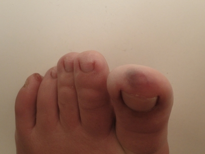 Mole on my little toe and bruised big toe