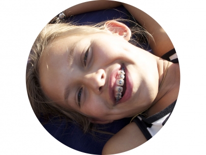 beugelsmile